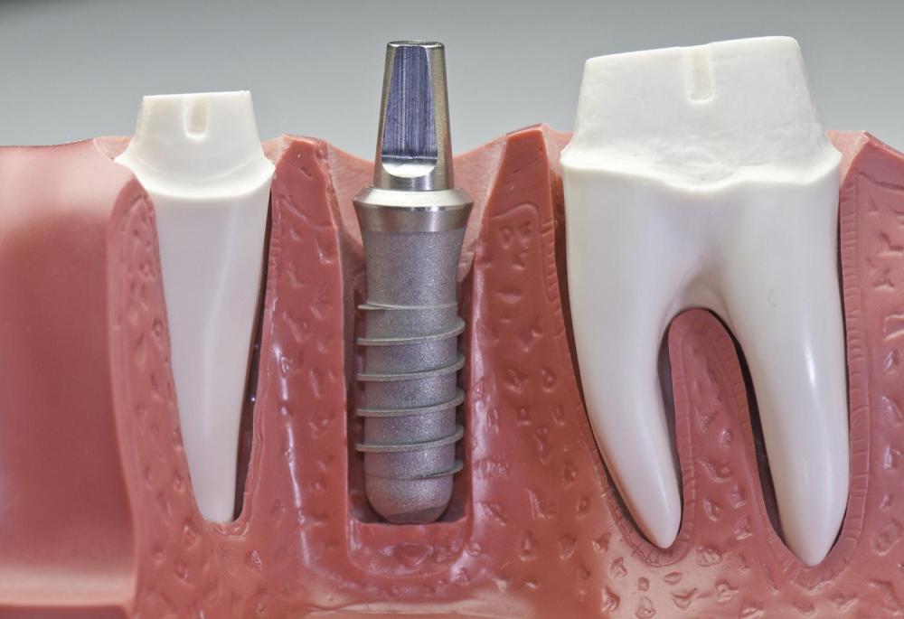 implant dentaire